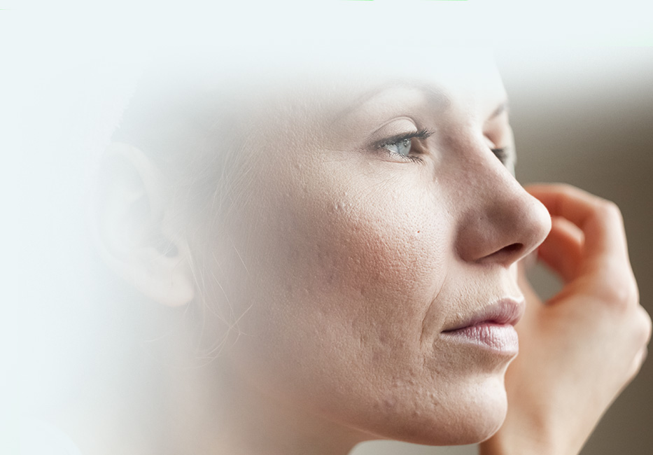 Rosacea Rosacea